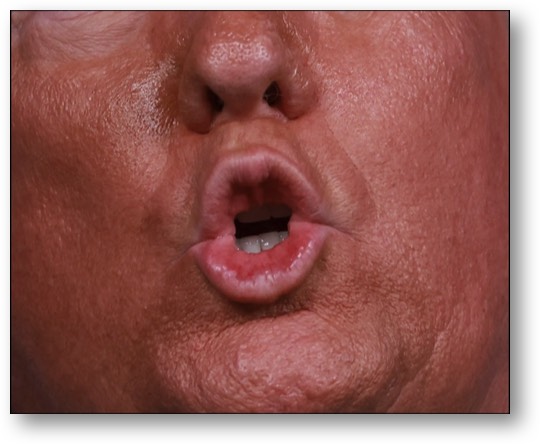 Trump is in serious cognitive decline!